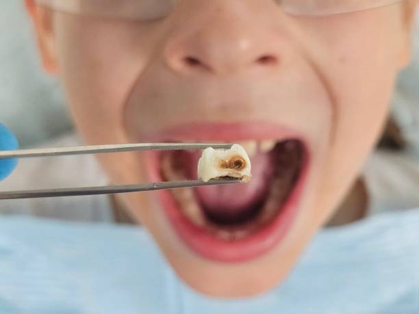 Best Emergency Dental Care for Broken or Chipped Teeth in Rocky Point, NY